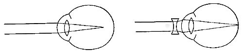 FIG. 81.—The nearsighted eye. The defect is remedied
by concave glasses.